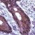 Immunohistochemistry-Paraffin: TIMP1 Antibody [NB100-1916] - Immunohistochemical analysis of human colon carcinoma.